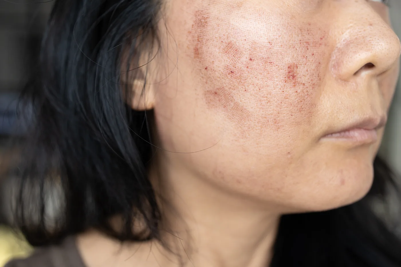 Glutathione drip for dull and pigmented skin brightening in Mumbai