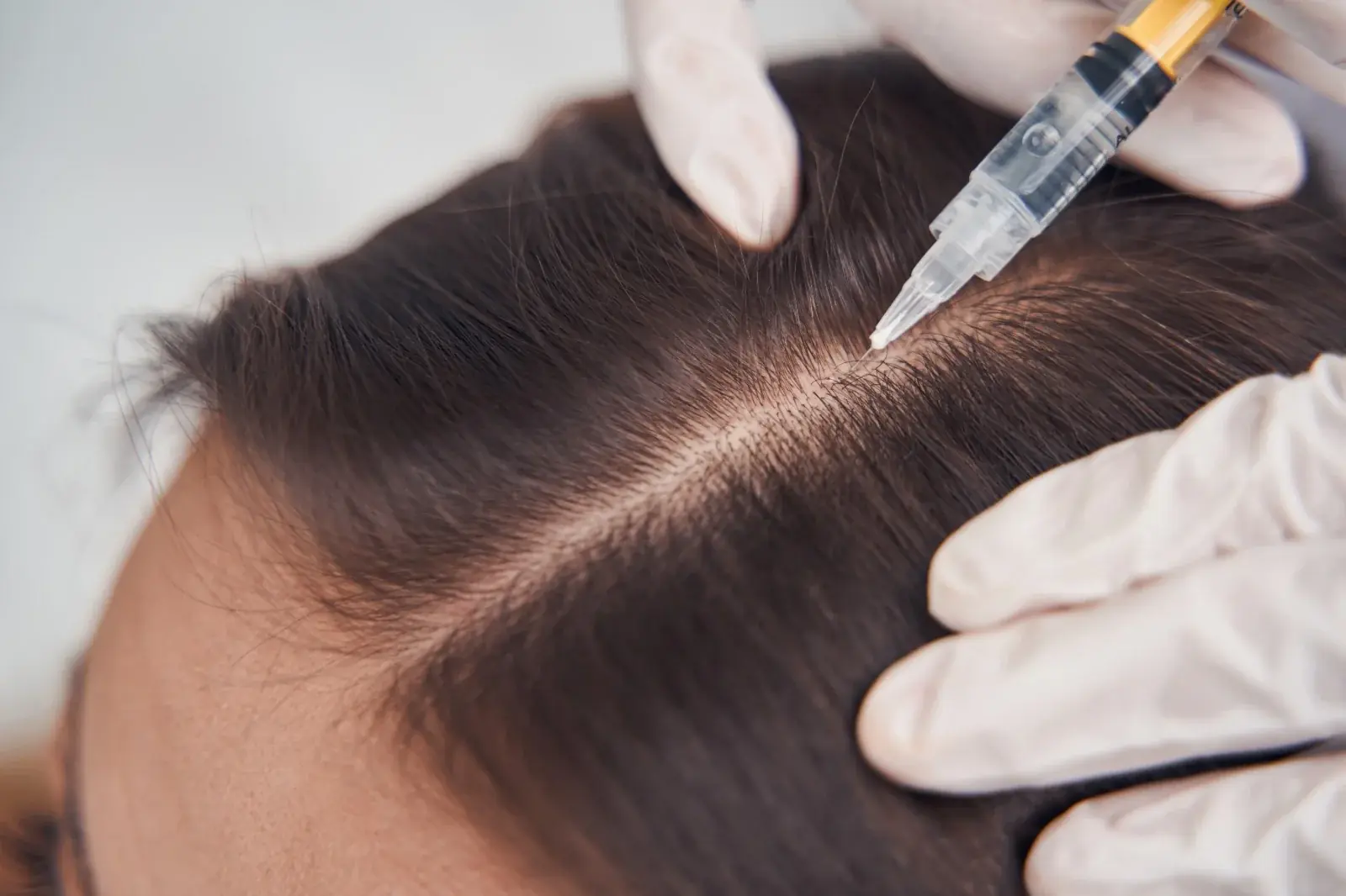 GFC hair treatment for early thinning and hair fall concerns