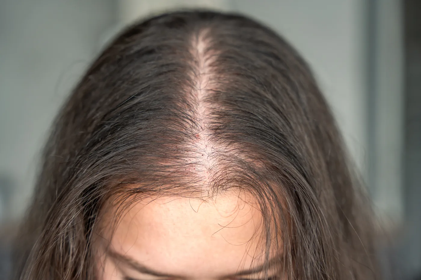 Early hair thinning and diffuse loss