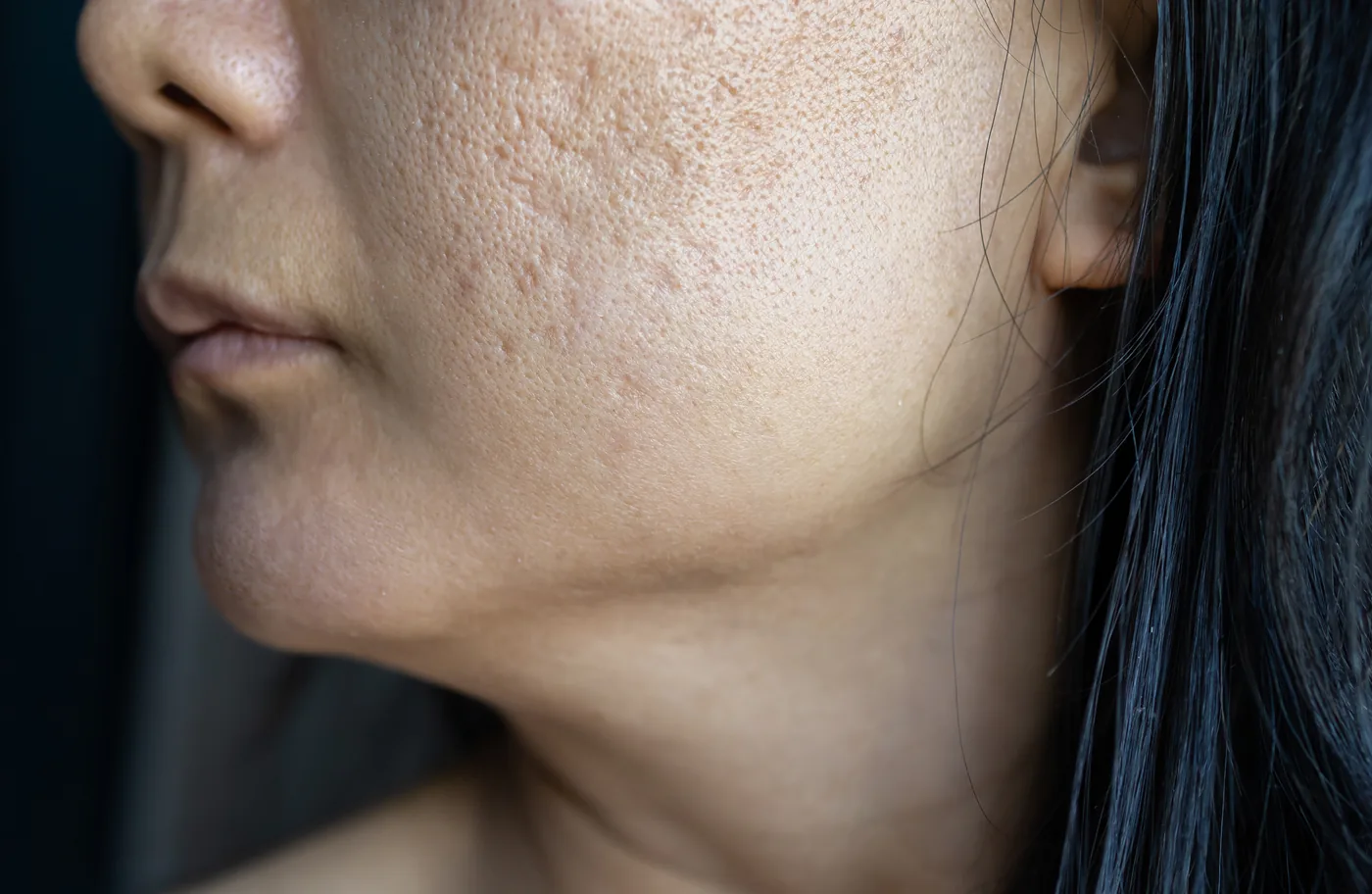 Face PRP for adults with acne scars and uneven skin texture