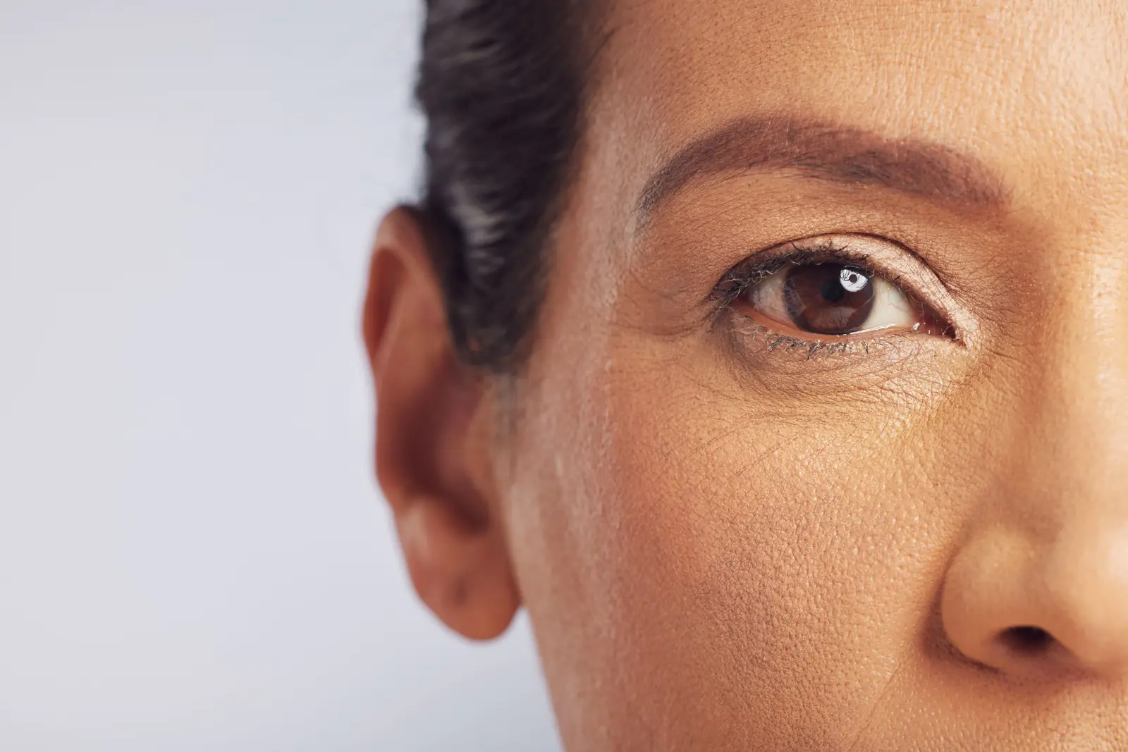 Botox for dynamic wrinkles and expression lines