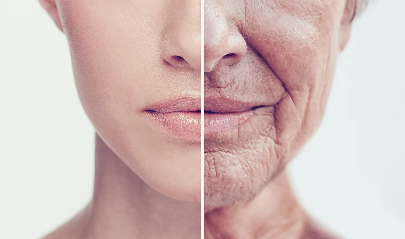 Thread Lift for mild to moderate skin sagging