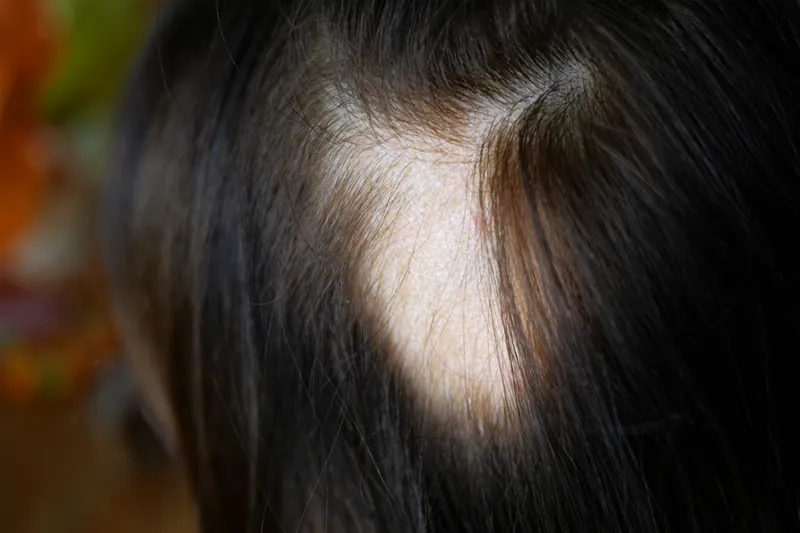 Androgenetic Alopecia