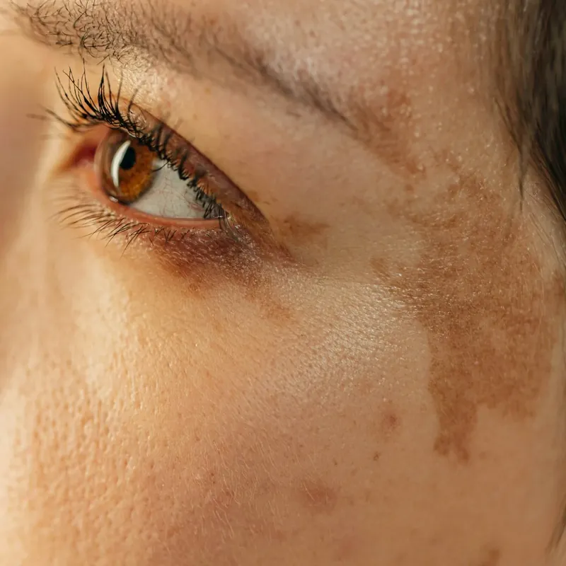 Uneven Skin Tone