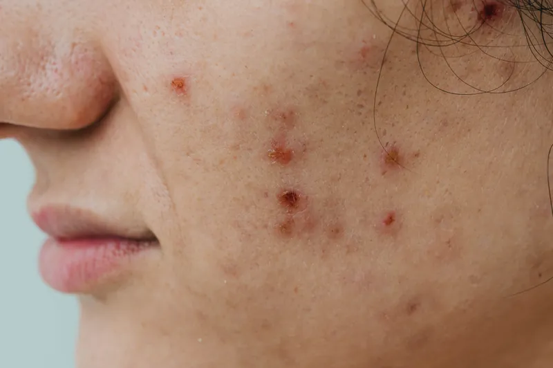 Acne Marks