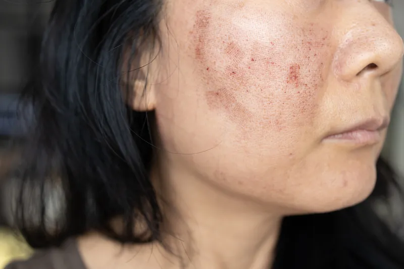 Melasma & PIH