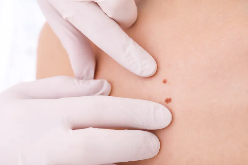 Skin Tags, Warts & Keloids
